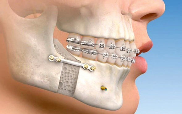 RECUO MAXILO-MANDIBULAR - CLINICA DA FACE