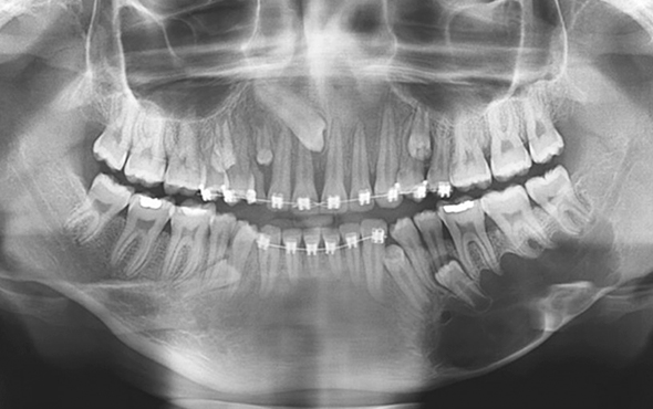 Cirurgia-de-cistos-e-tumores-da-região-maxilofacial